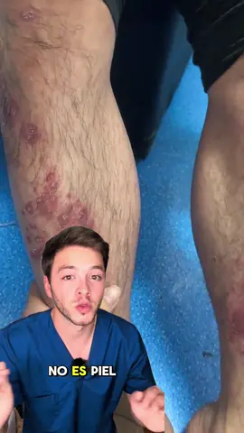 No podía dejar de rascarme las piernas... sangraba cada noche. #PsoriasisPiernas #PsoriasisManos #AlivioDePicazón #PielAgrietada #CuidadoDeLaPiel #TikTokLoRecomienda #PsoriasisRelief #PsoriasisLegs #psoriasis #tiktokshop 