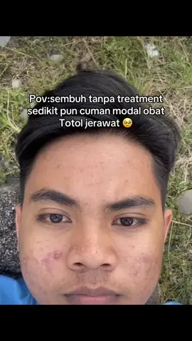Jerawatnya menyala banget 😭😭😭MasyaAllah sudah bisa lebih baik 🥹#jerawat #acnefighter #masukberandafyp #viral #jerawatan #acneprone #obatjerawat #obatotoljerawat #acnefighter #jerawat #omnsikin #VolcanicAsh#fyp 