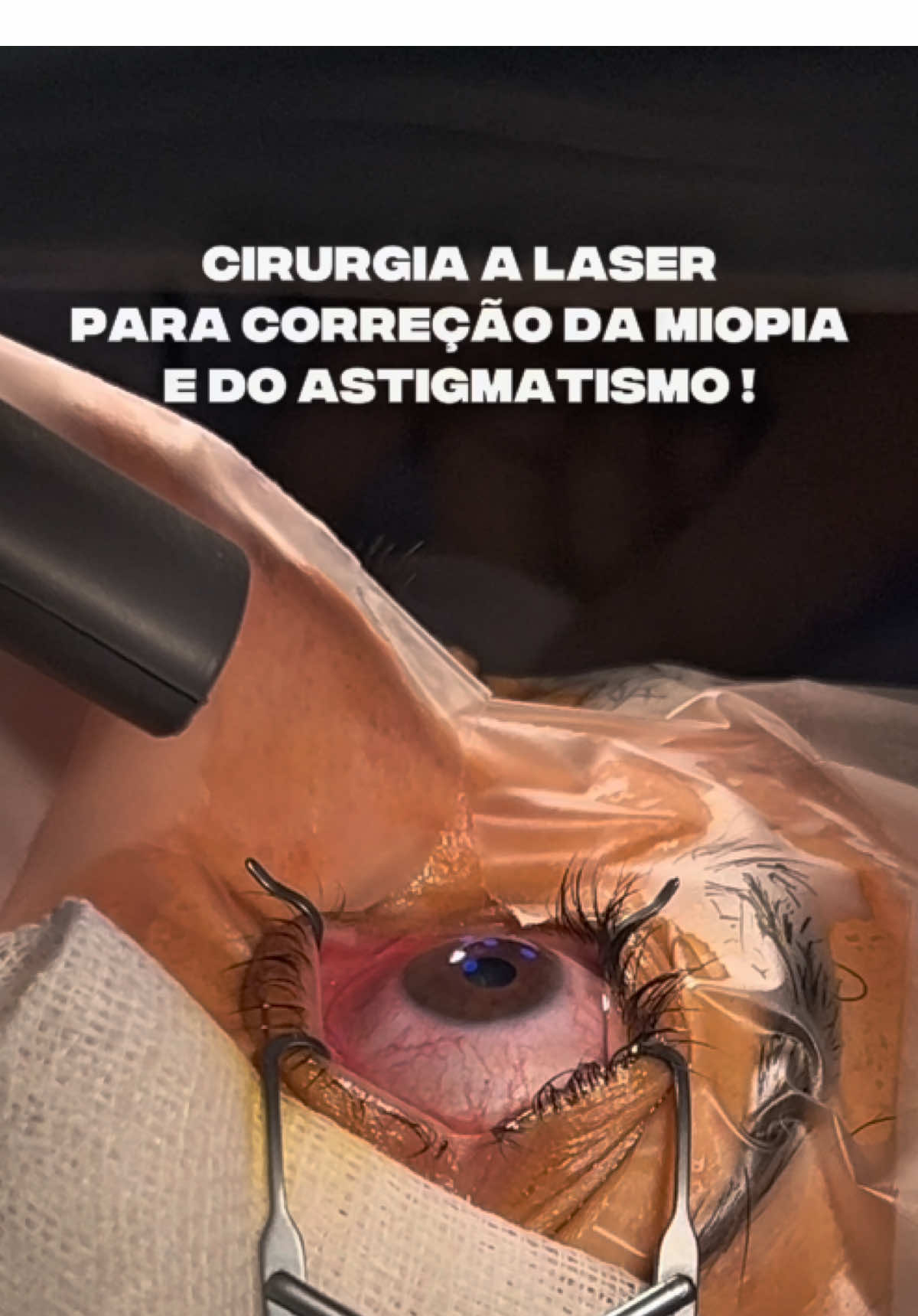 Cirurgia a laser para correção da miopia e do astigmatismo! O Laser Excimer é utilizado tanto na cirurgia PRK como no LASIK. Este laser de feixe pulsante de luz ultravioleta é aplicado na córnea para alterar a sua curvatura e corrigir o erro refrativo com máxima precisão. É uma solução segura e eficaz para tratar miopia, hipermetropia e astigmatismo, adaptada às necessidades de cada paciente. Quer saber se é candidato à cirurgia refrativa? Agende a sua consulta através do link na bio ou ligue para +351 213 105 650. #PRK #lasik #Oftalmologia #refractivesurgery #SaudeOcular #cirurgia #CirurgiaRefrativa 