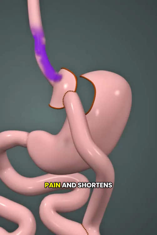 Gastric Bypass Surgery (3D Animation) #gastricbypass #gastricbypassjourney #stomachsurgery #gastricsurgery #gastricsleevesurgery #weightloss #weightlosssurgery #weightlossjouney #medical3danimation #3dmedicalanimation #bariatricsurgery #abdominalsurgeries #stomachbypass