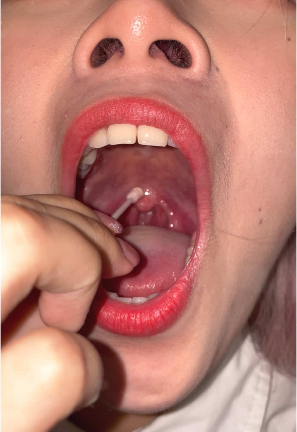 #chinagir #Cap #tonsil #examination囗腔桧查 