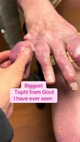 I’m very familiar with gout. But I have never seen Tophi from gout this big.            Long term gout attacks can cause Tophi - hard chalky lumps under the skin. Made of build up Monosodium Urate crystals.                   Gout is a type of inflammatory arthritis caused by the buildup of uric acid crystals in the joints. It often comes on suddenly and is extremely painful, most commonly affecting the big toe, but it can affect other joints as well (e.g., ankles, knees, elbows, fingers). 🔍 Causes of Gout 	•	High uric acid levels in the blood (hyperuricemia), which may result from: 	•	Diet high in purines (e.g., red meat, organ meats, seafood, alcohol—especially beer, sugary drinks) 	•	Obesity 	•	Kidney disease 	•	Certain medications (like diuretics) 	•	Genetics ⚠️ Symptoms of Gout 	•	Sudden and intense joint pain 	•	Swelling 	•	Redness and warmth over the affected joint 	•	Limited range of motion 	•	Often begins at night 🧪 Diagnosis 	•	Joint fluid test (to identify uric acid crystals) 	•	Blood test (to measure uric acid levels) 	•	Imaging (X-ray, ultrasound, or dual-energy CT scan) 💊 Treatment Options During an Acute Flare-Up 	•	NSAIDs (e.g., ibuprofen, naproxen) 	•	Colchicine 	•	Corticosteroids (oral or injected) For Long-Term Management 	•	Lifestyle changes (diet, weight loss, hydration) 	•	Urate-lowering therapy (ULT) if attacks are frequent: 	•	Allopurinol 	•	Febuxostat 	•	Probenecid 🍎 Lifestyle & Diet Tips 	•	Limit high-purine foods: red meat, shellfish, liver 	•	Avoid alcohol and sugary soft drinks 	•	Drink plenty of water 	•	Lose excess weight 	•	Exercise regularly, but avoid strenuous activity during flares. #gout #tophi #inflammation #uricacid #healthcareworkers #physicianassociate #signsandsymptoms #scrublife 