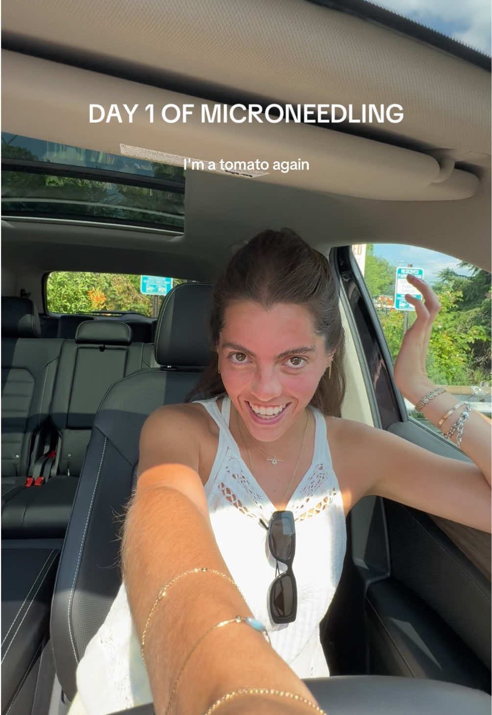 PART 2 | microneedling 🍅😶‍🌫️🫧  this is my skin immediately after! It’s giving…. Extremely sunburnt  🫡🦞  #exosomes #microneedling #microneedlingface #microneedlingbeforeandafter #acneskin #acnescars #scarremoval 