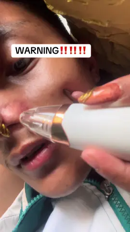 Hindi kona igate keep to bakit wala akong white heads Disclaimer: No medical claims, for Skincare purposes only.   #fyp #foryoupage #whiteheads #whiteheadsremoval #whiteheadsvacuumremover 