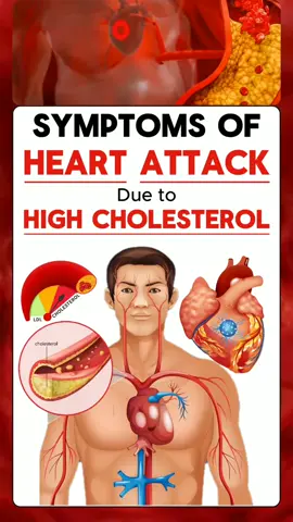 Symptoms of a Heart Attack Due to High Cholesterol. #hearthealth  #atherosclerosis  #angina  #breath  #heart #fatigue  #heartattack  #highcholesterol  #hearthealth  #cholesterolfacts  #heartattackrisk  #cholesterol  #badcholesterol  #ldl  #hdl  #heartsmart  #coronaryarterydisease  #heartdiseaseprevention  #cholesterolawareness 