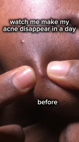 Simplest way to get rid of your pimples without having any dark spots on your face! Literally the simplest 3 step to get rid of acne overnight. All you need is the @VT Cosmetics US  ~Reedle Shot 700 ~Garlic Reedle Shot ~Garlic Point Patch And to prevent further breakouts you can use the Garlic Gel Cream! #vtcosmetics #vtgarlic #garlicreedleshot #garlic #garlicforclearskin #garlicforacne #acnetreatments #acnespottreatment #acneskin #pimples #acne #hormonalacne #cysticacne  #koreanskincare #kbeauty #glassskin #acneskin #hormonalacnejourney #acnefighter #acnejourney 