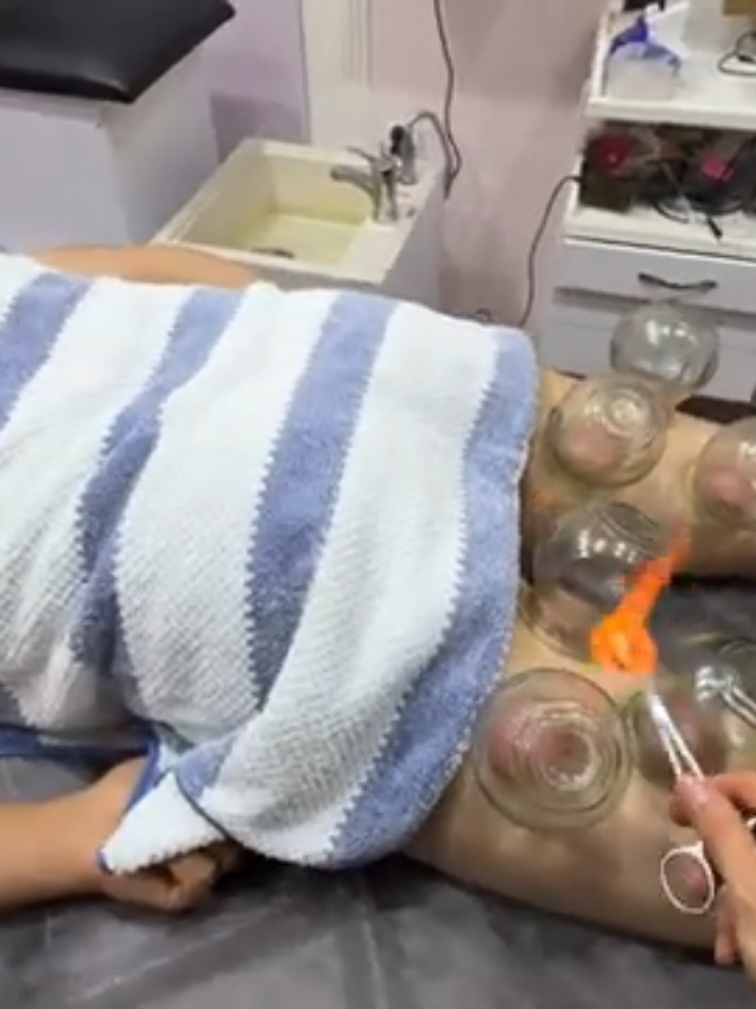 VIP Cupping ASMR 😂 . . . . . . . . . #explore  #viral  #cupping  #cuppingtherapy  #massage  #reels  #asmr  #fire  #pizza  #peperoni  #food  #keşfet