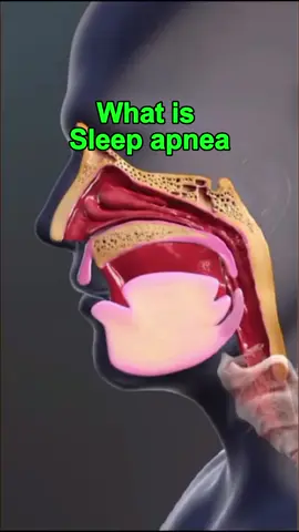 What is sleep apnea#healthtips #healthy #body #wellness #fyp #DidYouKnow #nowyouknow 