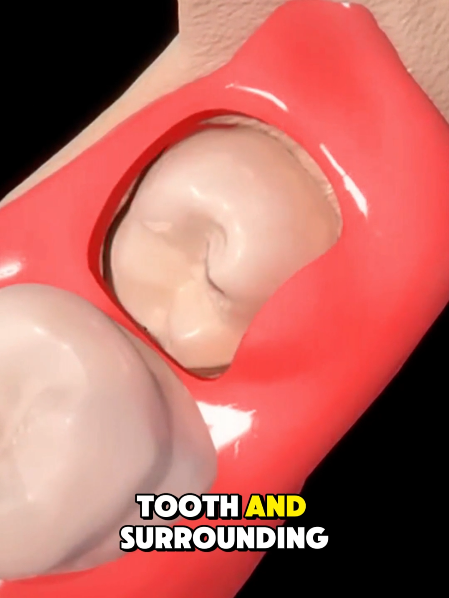 Wisdom Tooth Extraction Surgery (3D Animation) #3dmedicalanimation  #medical3danimation  #wisdomteeth  #wisdomtoothremoval  #wisdomteethextraction  #toothextraction  #dentalsurgery #toothremoval  #swollencheeks  #wisdomteethswelling 