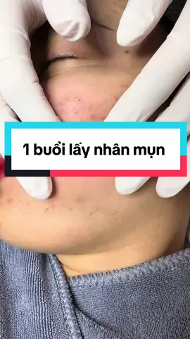 Kết hợp bôi thoa hoặc hoạt chất với lấy nhân sẽ rút ngắn quá trình hơn #trimuntritham #bslydalieu 