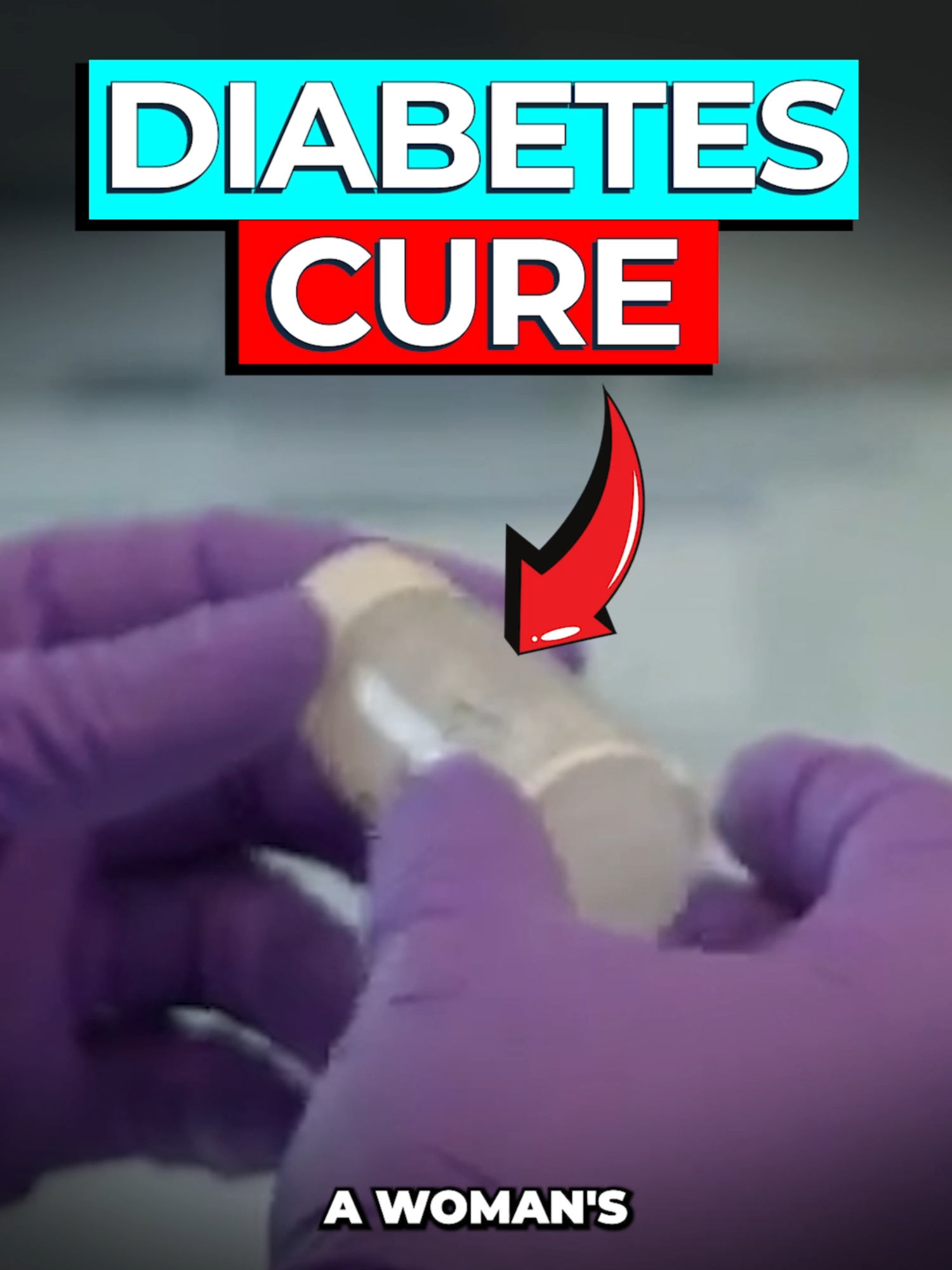Scientists Cure Woman's Type 1 Diabetes A single infusion of a stem cell-based treatment may have cured 10 out of 12 people with the most severe form of type 1 diabetes. One year later, these 10 patients no longer need insulin. The other two patients need much lower doses. Article here: https://www.nejm.org/doi/full/10.1056/NEJMoa2506549 #sciencetok #discovery #fyp