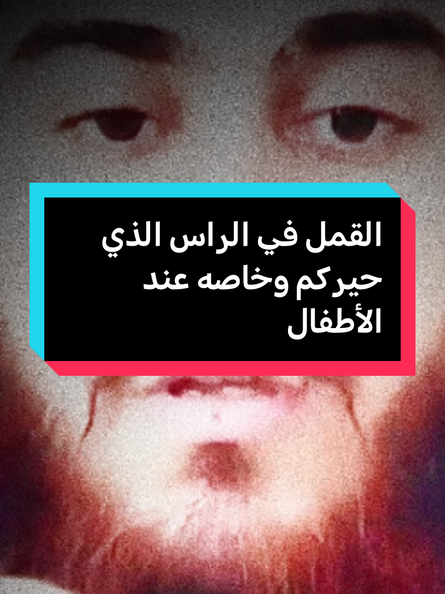 القمل في الراس الذي حيركم وخاصه عند الأطفال #fypシ #fypviralシ #فهدالقرني 