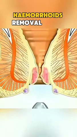 Haemorrhoids removal surgery   Ever wondered how haemorrhoids are removed Here's sape clear explanation . #Hemorrhoids #Surgery #HealthEducation #Doctor #Medical #digestivehealth #medicaleducation #LearnOnTikTok 