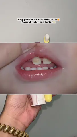 Yung akala ko tuluyan ng masisira kasi pabulok na, yun pla pwede pa masalba🥰 #hegerbabytoothpaste #toothpaste #kidstoothpaste #toothpasteforkids #tartar #yellowteeth #oral #oralhealth #oralhygiene #oralcare #hegerbabysheromom #hegerbaby #momcreator #momlife 
