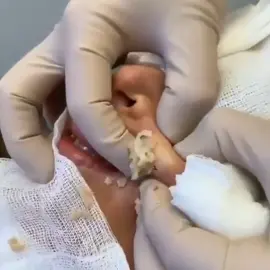 For more videos : notbored.blog Blackhead removal / Pimple popping / Pimple Patch  #pimpleremover #pimple #pimplepopping #popping #blackheadremoval #blackhead #acne #cyst #cystremoval #zit #skincare #pimplepopper #drpimplepopper #zits #pimplepatch #pimplepatcher