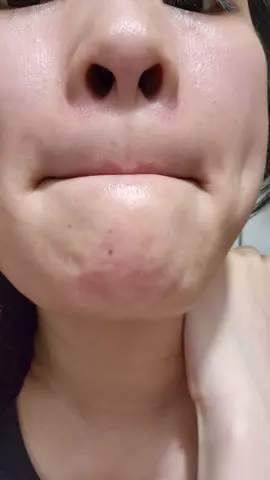 Sau gần 2 tháng kiên trì thì trộm vía cũng giảm được mụn ẩn #fyp #xuhuong #chamsocda #lamdep #skincare #damun 