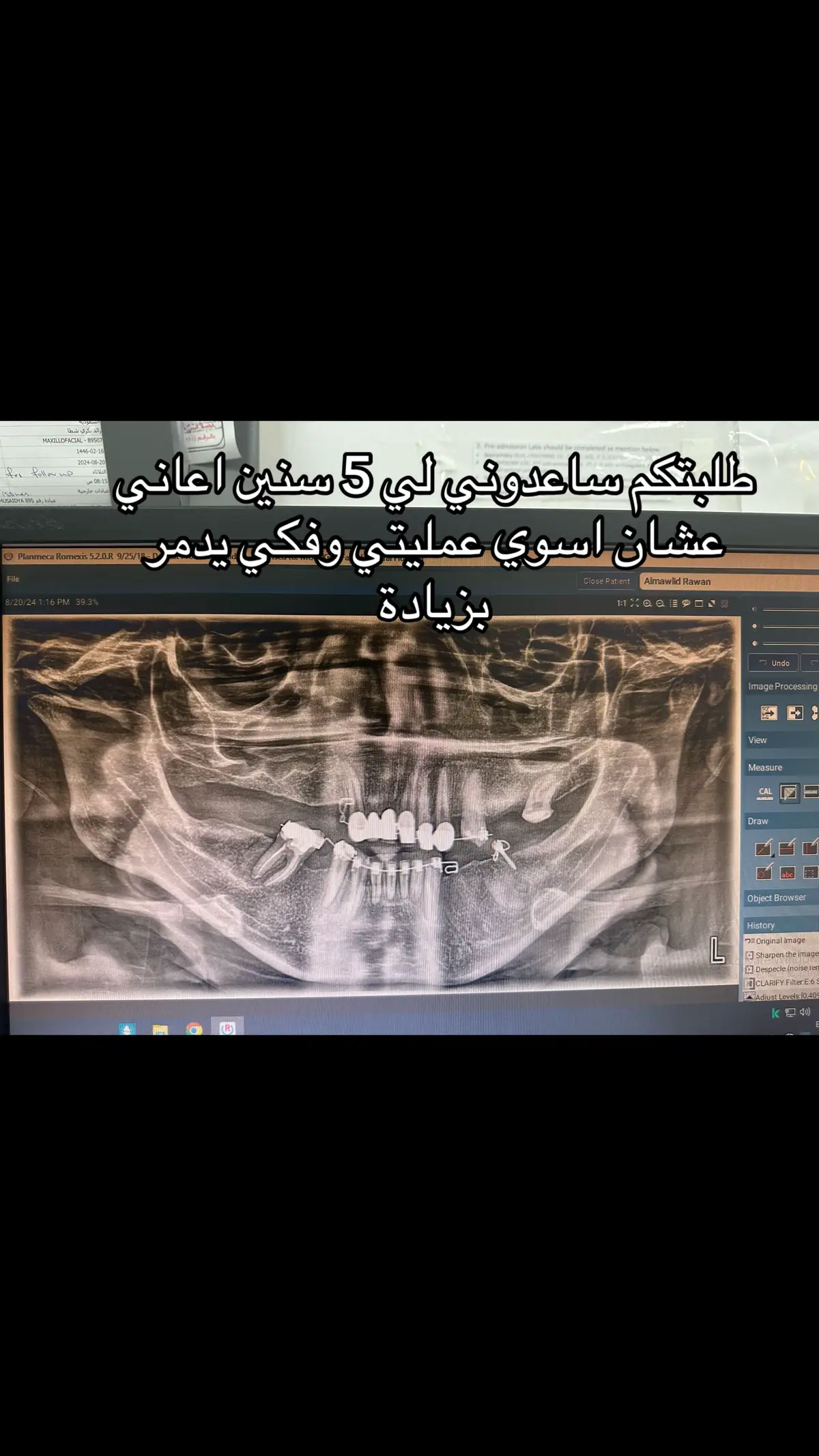#السعودية #الشعب_الصيني_ماله_حل😂😂 #البنات_للبنات #مالي_خلق_احط_هاشتاقات #عملية #تقويم_جراحي #شعب_طويق_العظيم 