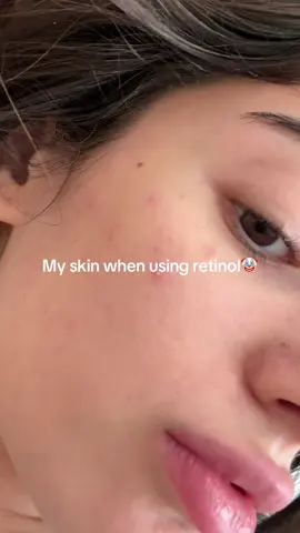Never going back to retinol, it makes my skin break out and dry😭 #retinol #retinolskincare #retinolserum #retinal #retinalserum #cleanserskincare 