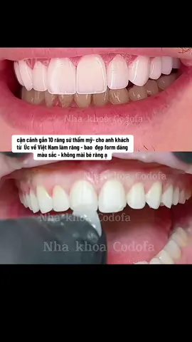 cận cảnh gắn 10 răng sứ thẩm mỹ- cho anh khách từ  Úc về Việt Nam làm răng - bao  đẹp form dáng màu sắc - không mài bé răng ạ #răng_sứ_thẩm_mỹ #dánsứveneer #khôngmài_nhỏ_răng #nhakhoacodofa #trám_răng_thưa #cầurăngsứ #trámrăng_sứt_mẻ #trám_răng_chuột 