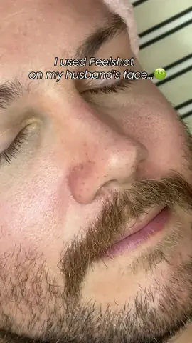 Since I started using Dr. Melaxin Peelshot, I haven’t been shocked by my husband’s dead skin. Armpits, elbows, neck, feet Use it everywhere. It’s super gentle. I tried it on all the rough spots, and I can literally see his skin getting clearer. This is, Only those who've used it will know. Really. #PeelShot #deadskingone #KbeautyFinds #GlowUp #beforeafter #Drmelaxin #peelshot #drmelaxin #skincare