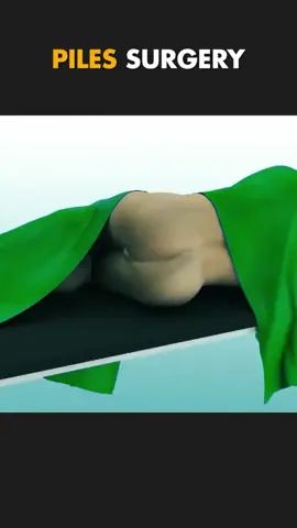 piles surgery  #pilesurgry #removalpiles 