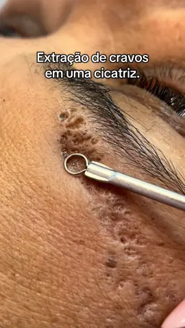 Vejam essa extração de cravos em uma cicatriz. 😍  #esteticafacial #LimpezaDePele #remoçãodecravos #cravosgigantes #cravossatisfatorios #blackhead #blackheadsremoval #tirandocravo 