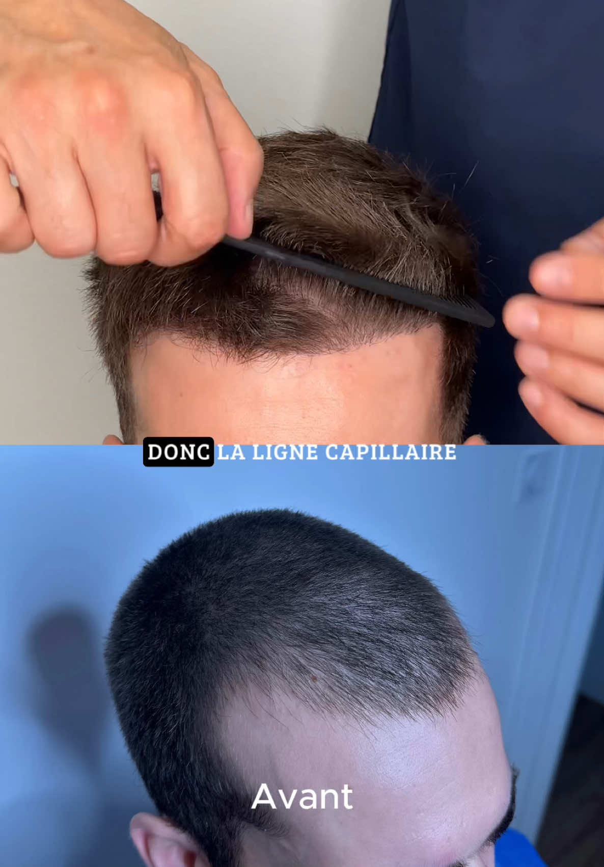✨ Résultat à 5 mois post-greffe capillaire sur les golfes ✨ La repousse est déjà bien visible, avec un dessin de ligne frontale naturel qui redonne de l’harmonie au visage. Le travail n’est pas encore final (le résultat continue d’évoluer jusqu’à 12 mois), mais le changement est déjà spectaculaire. 💇‍♂️ 📍 Réalisé au Cabinet du Dr Bodnar à Toulouse #GreffeCheveux #ImplantCapillaire #RésultatGreffe #AvantAprès #GreffeCheveuxToulouse #FUE #HairTransplant #HairRestoration #HairClinic #HairDoctor #ChirurgieCapillaire #Calvitie #RepousseCheveux #LigneFrontale #GolfesFrontaux #PerteDeCheveux #CheveuxHomme #Cheveux #DensitéCapillaire #HairLossSolution #HairGrowth #HairTransformation