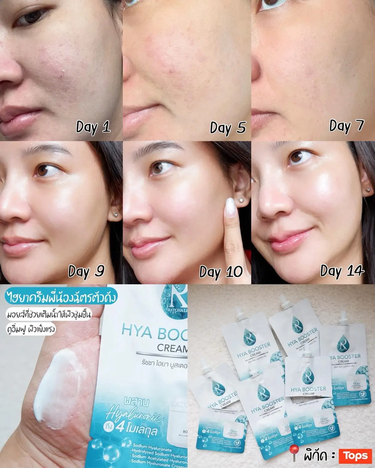 Hyaluronic Cream Nong Tiered Intense Formula. Kết hợp 4 loại Hyaluronic. Nuôi dưỡng sâu lớp da. Làm sáng da mọng nước, dưỡng ẩm, 0,. Bất cứ ai có làn da tồi tàn, mặt xỉn màu, trang điểm không bền. Khuyến khích ở tất cả. !! Sử dụng nhiều gói thực sự tốt.#xh 