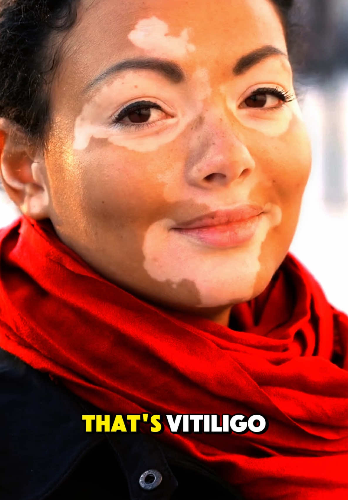 Why Is My Skin Losing Color? The Truth About Vitiligo. #skin #lose #color  #Vitiligo #SkinCondition #AutoimmuneDisorder #SkinHealth #PigmentLoss #TikTokDoctor #DermatologyFacts #HealthAwareness #MedicalExplained #SkinJourney #SelfLoveSkin #ModernMedicine #ChronicCondition #VitiligoAwareness #WellnessTalk