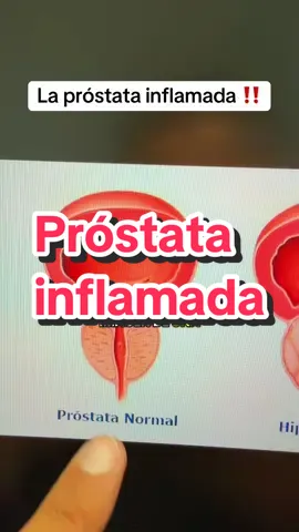 Suplemento de plantas para la inflamación de la próstata en hombres hispanos con 35 años o más #resultsmayvary #dealsforyoudays #prostata #sawpalmetto #oxidonitrico 
