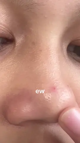 malah jd lunak bgt komedonya😭 #skincare #blackheadsremover #focalskin #focalskincare 