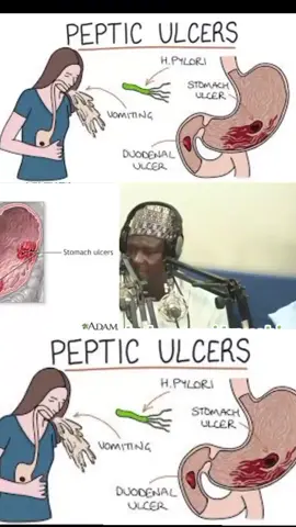 STOMACH ULCER #creatorsearchinsight #foryoupage #kanotiktok #CrosRiver #Borno #yobe #sokototiktokers #jigawatiktokers #libiya🇱🇾 #nigerniamey🇳🇪 #kebbitiktok #viril_video #nigermaradi🥰😘💯💞 #nigeriantiktok🇳🇬 #saudiarabia🇸🇦 #highlight #following #fyg #zamfaratiktok @C E O DR YAHAYA ABDULLAHI @ALMALEEK HERBS AND MEDICINE 💊 @DR. ISMAIL AMINU @Dr Khaleepha Herbal medicine 