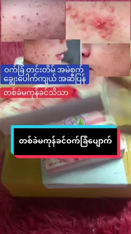 #ဝက်ခြံတင်းတိတ်အမဲစက်များအတွက် #မျက်နှာသစ်ဆပ်ပြာ #ခြင်းဝါလေးထဲဝင်ဝယ်လို့ရတယ်ရှင့် #phaw63882 #phaw #tranding #tiktok #ရောက်ချင်တဲ့နေရာရောက်👌 