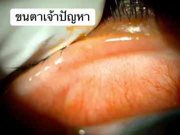 ขนตาเจ้าปัญหา #หมอชัยชาญ #จักษุแพทย์ #เพชรบูรณ์คลินิค #Ophthalmologist #เพชรบูรณ์ #สิ่งแปลกปลอมเข้าตา #ขนตา 