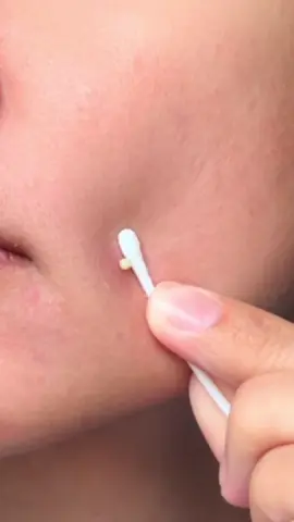 Acne patch yang sejauh ini aku pake terus, bikin jerawat mendemku cepet mateng kaya gini, dia juga gak bikin bopeng, trust me, ini bagus banget.. 