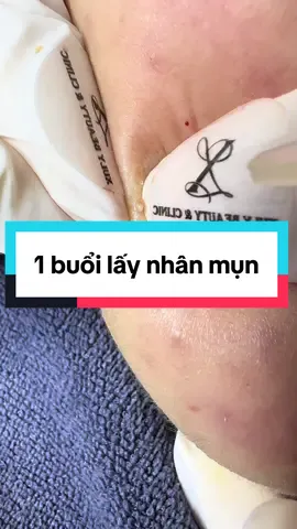 1 buổi lấy nhân mụn cơ bản có gì? #trimuntritham 