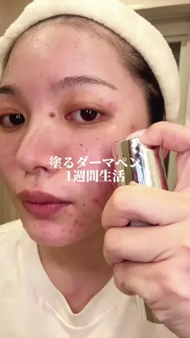 話題の針美容液1週間試してみた結果、、！ KATANダーマヒットセラムだよ✨ #PR #カタン #ダーマヒットセラム #肌改善 #ニキビ跡 #針美容液 #スキンケア 