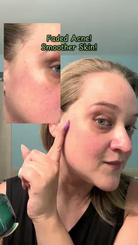 3 days! That’s all it took! Zinc Teca Blemish Serum by @bringgreen_official is THAT girl! Grab it on Amazon, I have it in my storefront.  #bringgreen #zincteca #kbeauty #koreanskincare #gentleskincare #pimple #acnesafe #gentleacne #acne #clearskin #oilyskin #niacinamideserum #summerskincare #amazonfinds #primeday #skincarereset #beforeandafter @4AM Marketing – Saebyeok Naesi 
