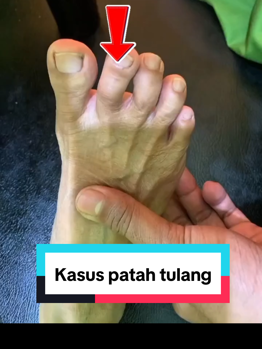 Pentingnya memahami sebab utama..untuk tindakan selanjutnya.. berikut penanganan kasus patah jari kaki, Alhamdulillah rilis, tinggal masa pemulihan.  . . . #sangkalputung #dislokasisendi #patahtulang #keseleo #terkilir #cideratulang #tulangpatah #viral #pengobatan #tradiosonal #acl #dislokasi #tiktok  #pengobatantradiosonal #pengikut #sorotan #fyp  #sangkalputungbudi #bsp  #tulangpatah #tulangbengkok #yanmu #kaderyanmu #intiraga