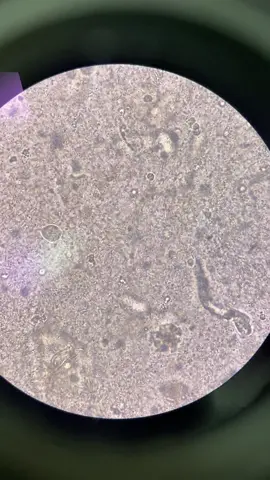 Bacteria in urine sample under microscope. 🔬 #fypシ #MLS #medtech #medtechlife #laboratory  #creatorsearchinsights 
