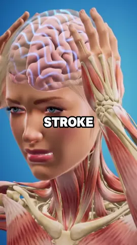 What is stroke? What are the early signs? #healthy #healthtips #healthtip #nutrition #heart #stroke 
