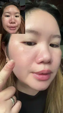 Nakaka tuwa lang talaga na Napa lighten Nya yung mga dark spot Ko sa face #vgobeauty #vgo #vgofrecklesremovercream #fyp #foryou 