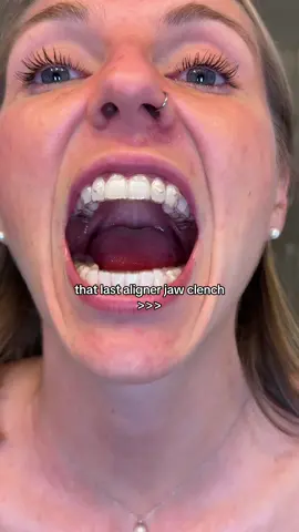 13/13 babyyyyyy!! #invisalign #invisalignsmile #invisalignjourney #mouthasmr #invisalignasmr 