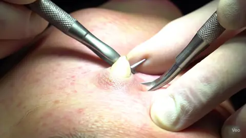 #pimplepopping, #pimplepopper, #AIbeauty, #skincare #glowingskin #pimplepopping #pimplepopper #AIbeauty #skincare #glowingskin #satisfying #foryou #trending2025 #กดสิว #คลิปสบายตา #สิว #สิวอุดตัน #สิวai 