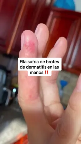 ¿Tus manos te arden, están secas, con grietas o te da vergüenza mostrarlas por los brotes? Te entiendo... Muchas personas conviven con eczema desde la infancia, pero otras comienzan en la adultez, uno de los mayores detonantes en esta etapa de la vida es el estrés y aprender a manejarlo puede marcar una diferencia 💆‍♀️. Nosotros estamos aquí para ayudarte, te recomiendo para reducir los síntomas relacionados con el eczema, inciar con nuestra crema Soaked, el aceite Gold, y el bálsamo Sleekly, si tienes heridas abiertas, también puedes usar nuestro nuevo bálsamo Zinkly 🌿 Escríbenos si necesitas guía... No tienes que pasar por esto sola. Estamos para apoyarte ❤️🙏🏽. #eczema #dermatitis #eczemaakincare 