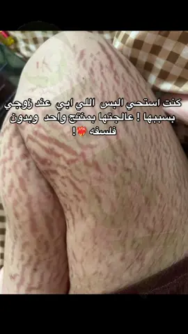 لكل الي تستحي من تشققات جسمها الحل عندي 😍#علاج_تشققات_الجسم #التشققات_البيضاء_والحمراء #سيروم_ويزا 