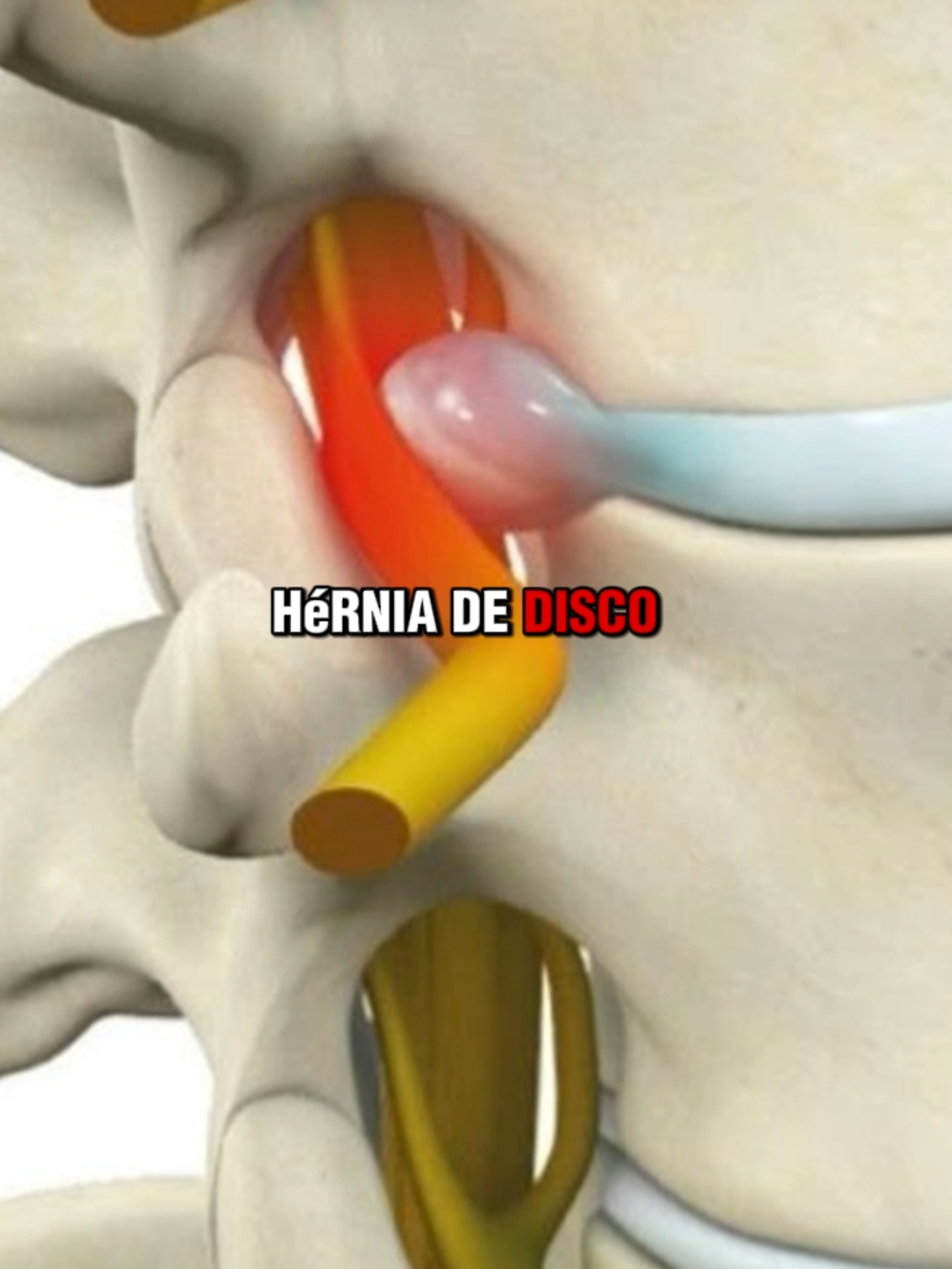 #coluna #dornascostas #dornacoluna #dornalombar #colunatravada #colunavertebral #semandar #dor #escoliose #cirurgia #cirurgianacoluna #doresnascostas #quiropraxia #fisioterapia #medico #hospital #internação