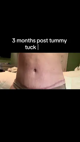 What are you using for scar treatment? I haven’t seen much change yet in mine #tummytuck #healing #scarupdate #tummytuckjourney #mom 