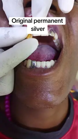 #dentalfillings #braces #OpenWeekends #dentalfillings #permanentreplacement #crowning #scalingandpolishing😁😍 