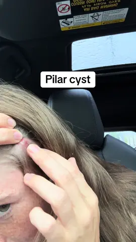 Before anyone says anything lol no it’s not dandruff and no it’s not lice haha. It’s fuzz from a hat #pilarcyst #cyst #pimple #fyp 